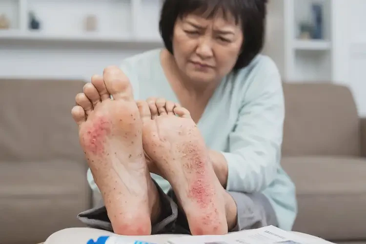 女生腳上容易起濕疹能夠徹底治愈嗎(圖4)