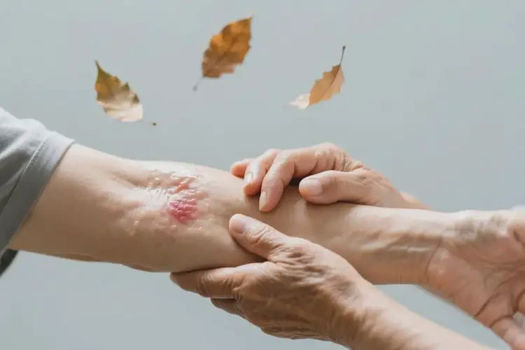 老年人手臂出濕疹可不可以根治(圖1)