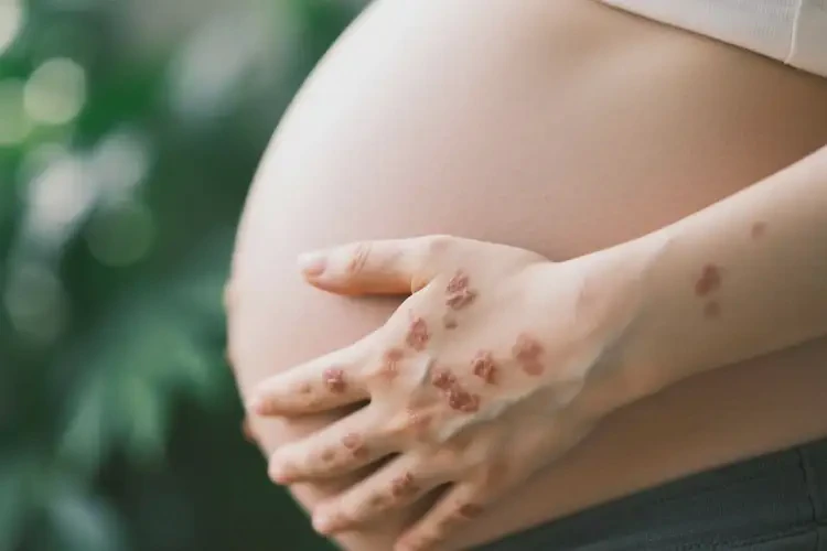 孕婦手臂偶爾起濕疹不管它會(huì)自己好嗎(圖2)