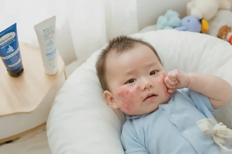 寶寶屁股上偶爾起濕疹可不可以根治(圖4)