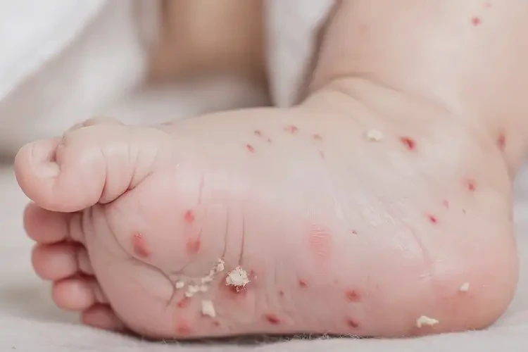 嬰兒腳上偶爾長(zhǎng)濕疹可不可以根治(圖4)