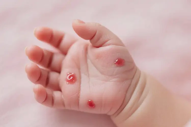 新生兒手上長(zhǎng)濕疹可不可以根治(圖4)