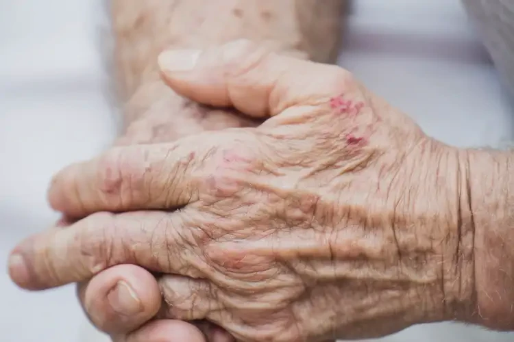 高龄老人手上偶尔起湿疹能不能根治(图4)