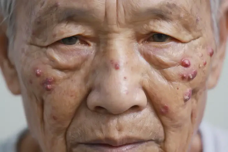 高齡老人面部偶爾起濕疹能不能根治(圖4)