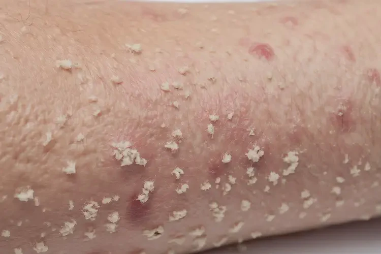 男人身上起湿疹能彻底自愈吗(图2)