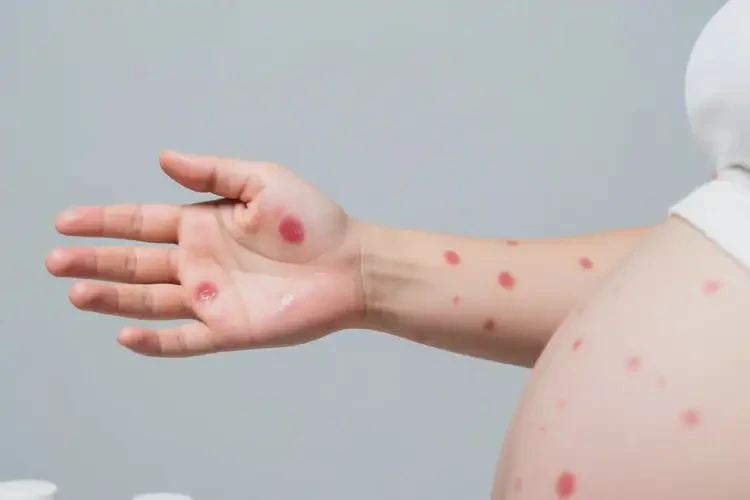 孕婦手臂起濕疹可不可以根治(圖2)