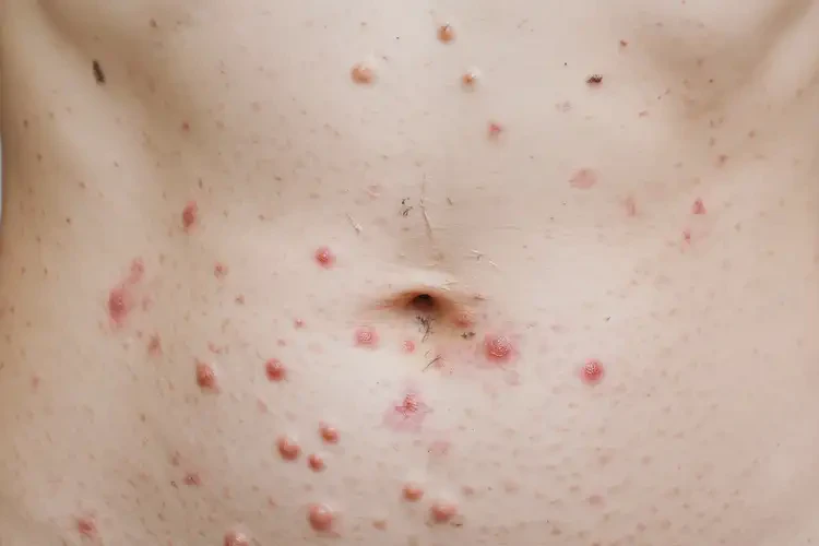 女生肚子上起濕疹可不可以根治(圖4)