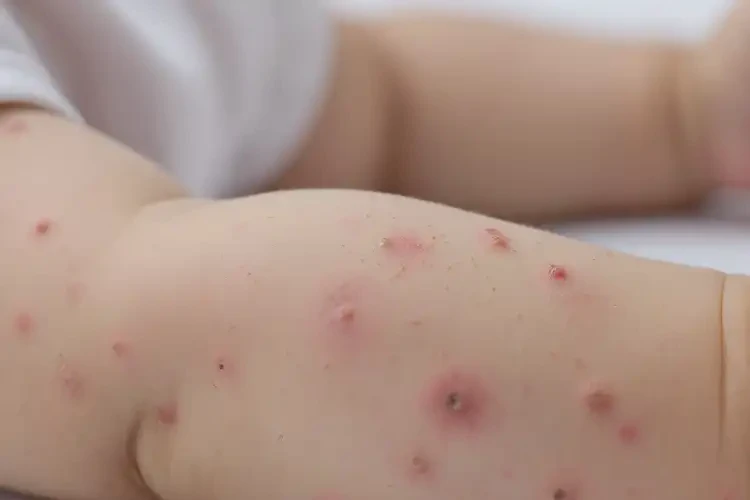 幼兒手臂上出濕疹可以徹底自愈嗎(圖4)