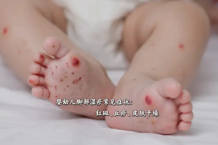嬰幼兒腳上容易長濕疹可不可以根治(圖4)
