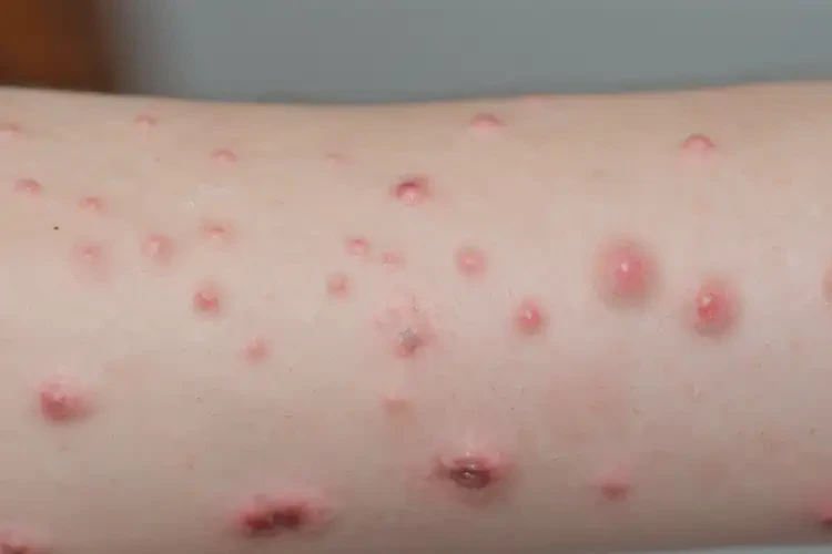 少兒手臂上出濕疹可不可以根治(圖4)