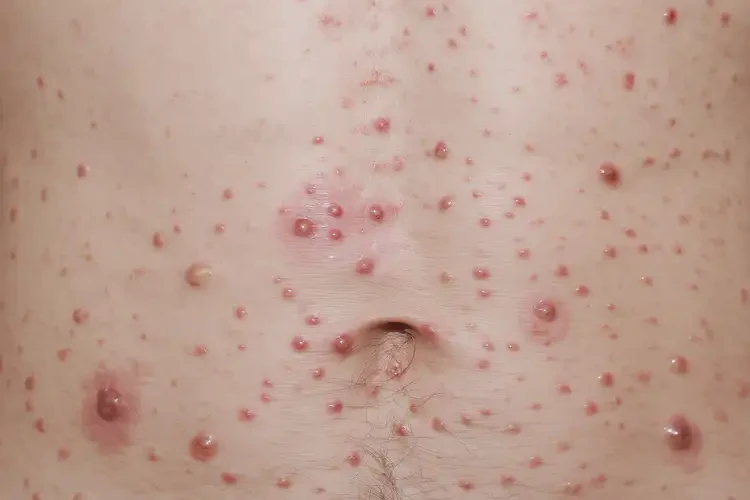 青年人屁股上經(jīng)常起濕疹不管它會自己痊愈嗎(圖4)