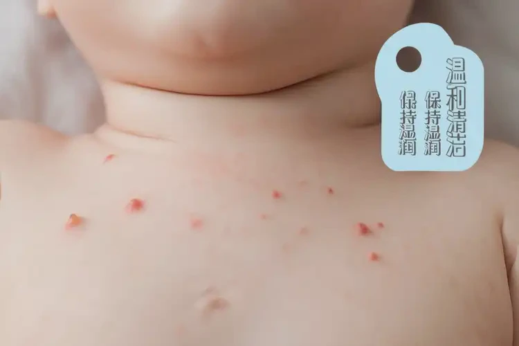 寶寶脖子上容易長濕疹不管它會自己痊愈嗎(圖4)