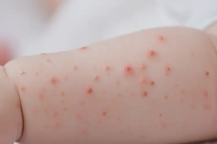 宝宝手臂有湿疹可不可以根治(图4)