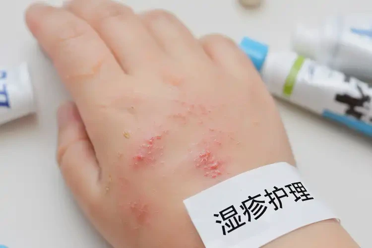 小孩手上偶爾起濕疹可不可以根治(圖4)