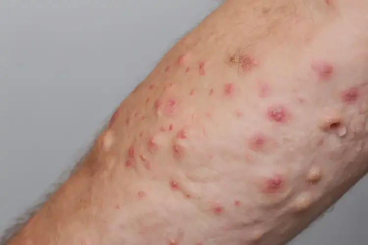 男人手臂長濕疹能不能根治(圖3)