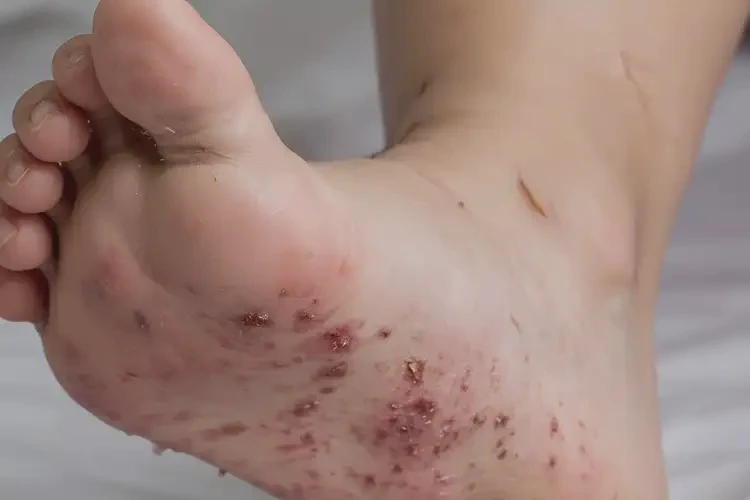 孩子腳上出濕疹能靠自己自愈嗎(圖4)