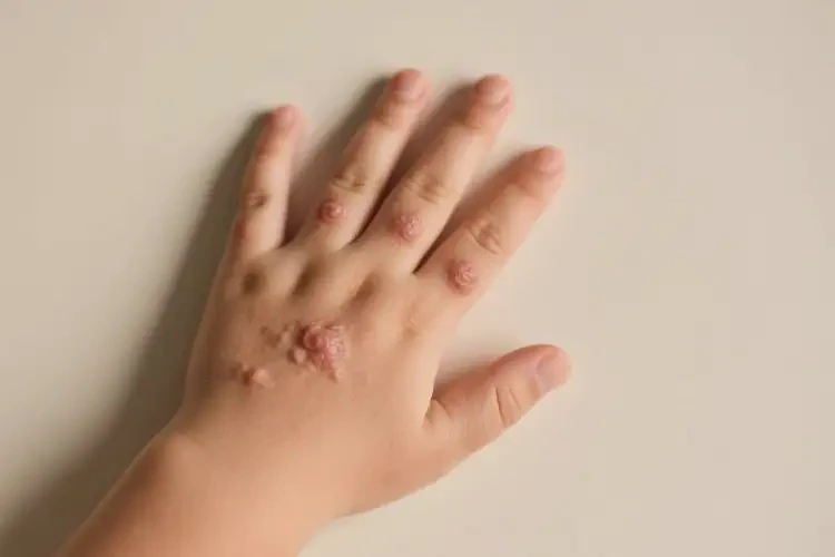 儿童手上容易长湿疹可不可以根治(图2)