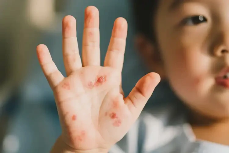 儿童手上容易长湿疹可不可以根治(图4)