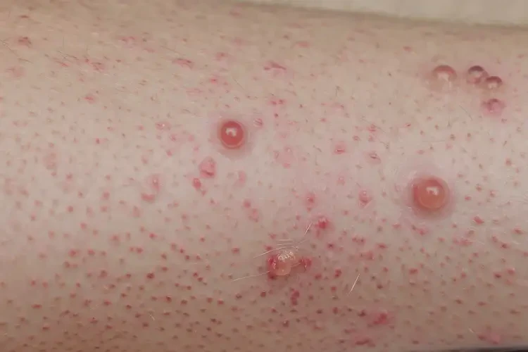 大學(xué)生大腿長濕疹不管它會自己好嗎(圖4)