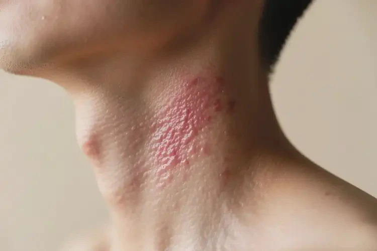 男人脖子偶爾起濕疹不管它會(huì)自己痊愈嗎(圖4)