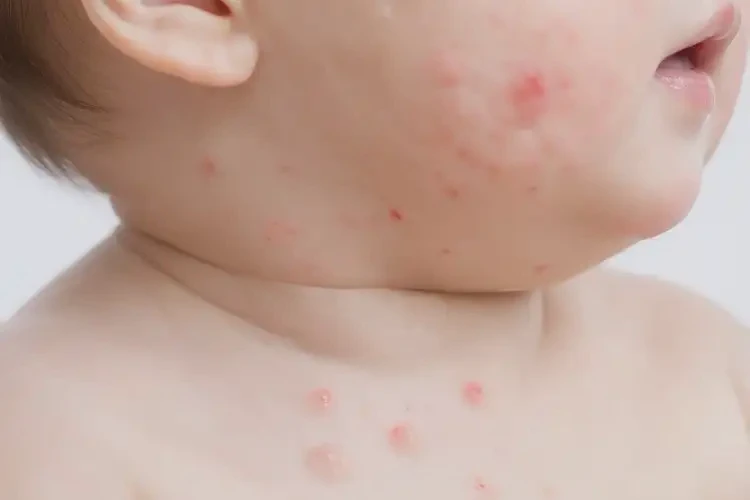 嬰幼兒脖子上容易長濕疹不管它會自己好嗎(圖4)