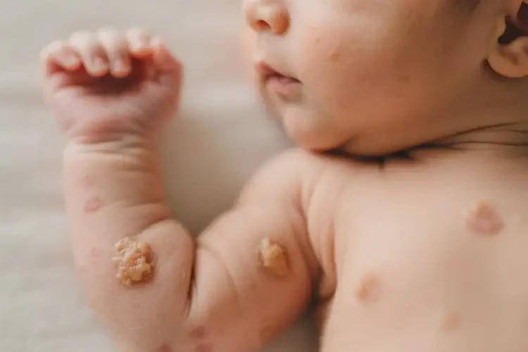 新生兒手臂長(zhǎng)濕疹不管它會(huì)自己痊愈嗎(圖4)