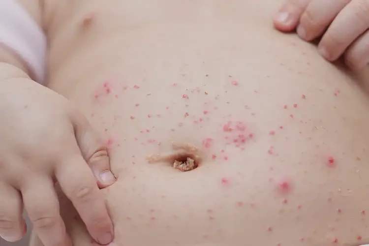 幼兒肚子上出濕疹可不可以根治(圖4)