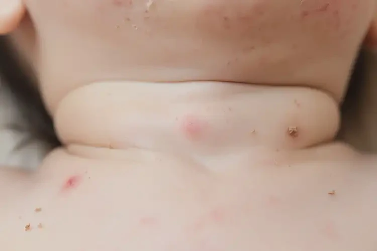 幼兒脖子有濕疹不管它會自己好嗎(圖4)