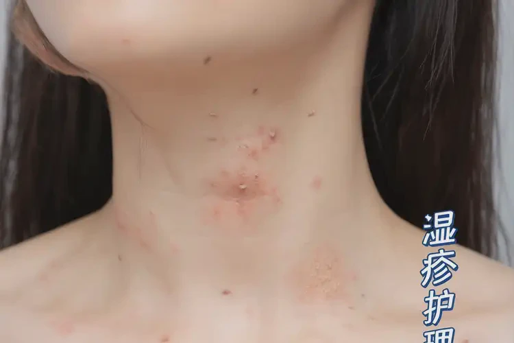 女人脖子上偶爾起濕疹可以徹底自愈嗎(圖4)