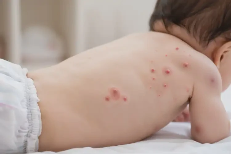 婴儿屁股上出湿疹可不可以根治(图4)