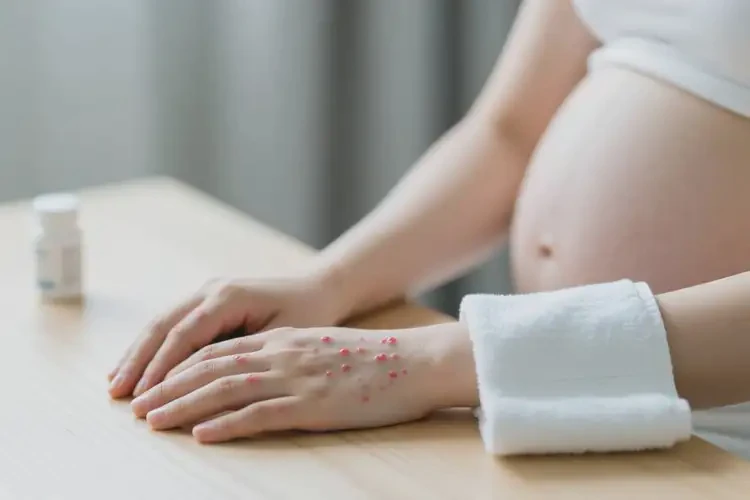 產(chǎn)婦手上經(jīng)常起濕疹可不可以根治(圖2)