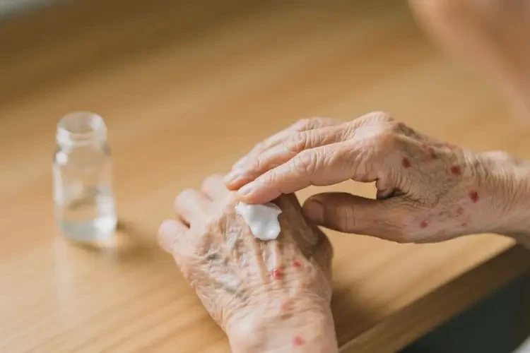 老年人全身容易起濕疹可不可以根治(圖4)