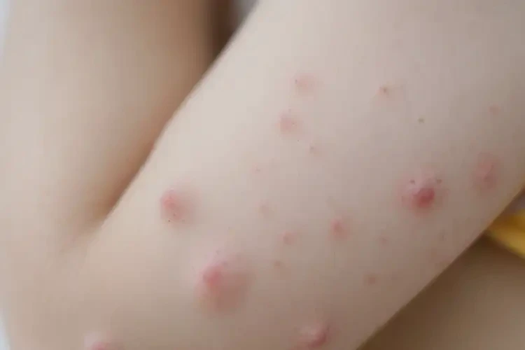 兒童屁股出濕疹能徹底自愈嗎(圖4)