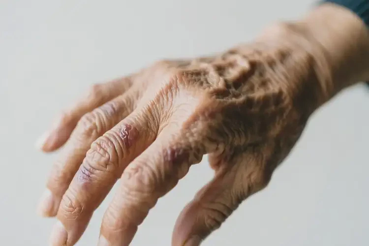 老年人手上有濕疹能徹底自愈嗎(圖1)