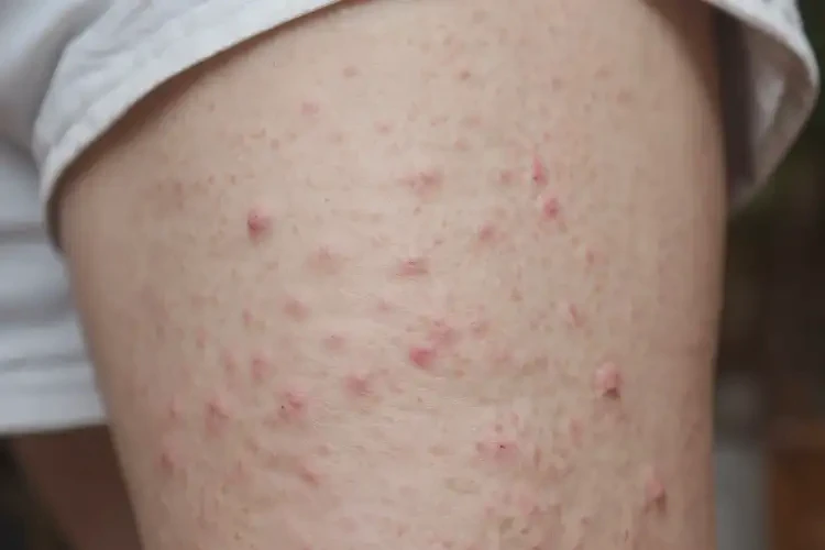 老年人大腿上出現(xiàn)濕疹可不可以根治(圖4)