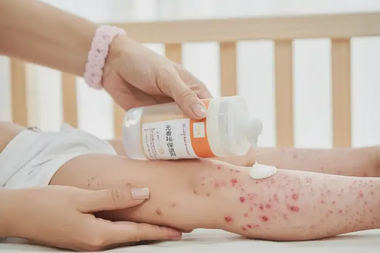 寶寶大腿容易長濕疹能夠徹底治愈嗎(圖3)