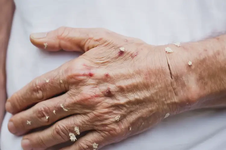 老年人手臂上出現(xiàn)濕疹可不可以根治(圖4)
