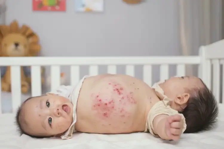 寶寶肚子容易起濕疹可不可以根治(圖4)