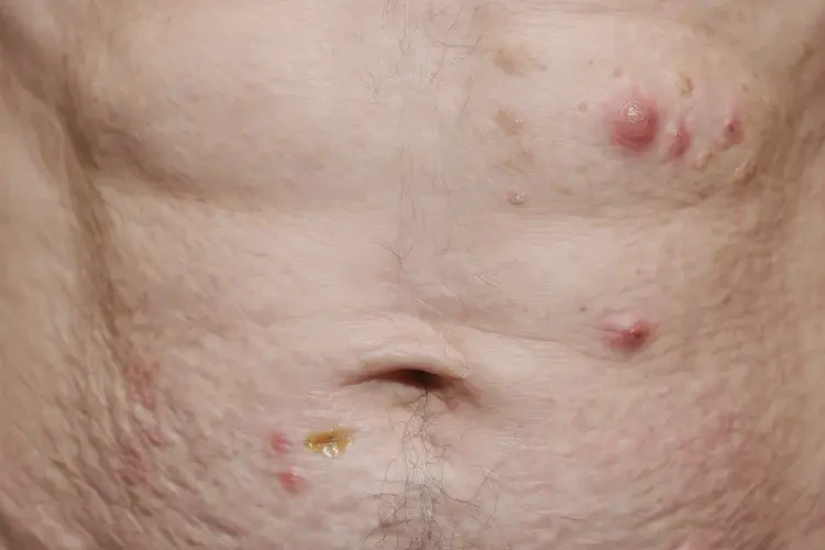 老人肚子上出現(xiàn)濕疹能靠自己自愈嗎(圖4)