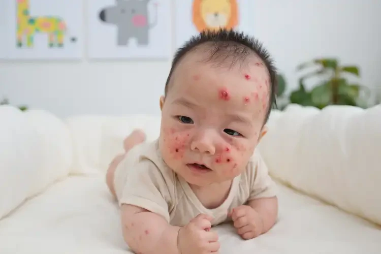 嬰兒脖子上偶爾長濕疹可不可以根治(圖4)