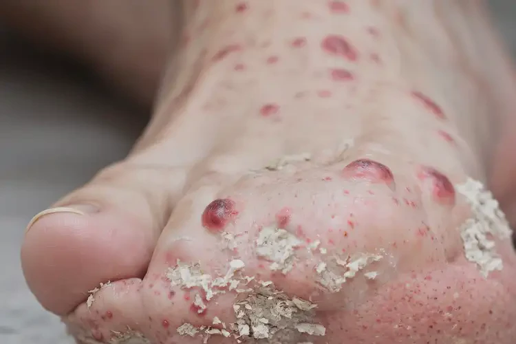 女人腳上偶爾起濕疹不管它會自己自愈嗎(圖3)