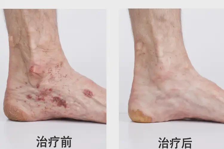 高齡老人腳上出現(xiàn)濕疹能不能根治(圖3)