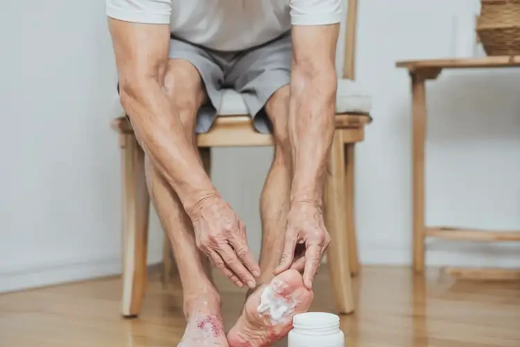 男性腳上容易起濕疹可不可以根治(圖1)