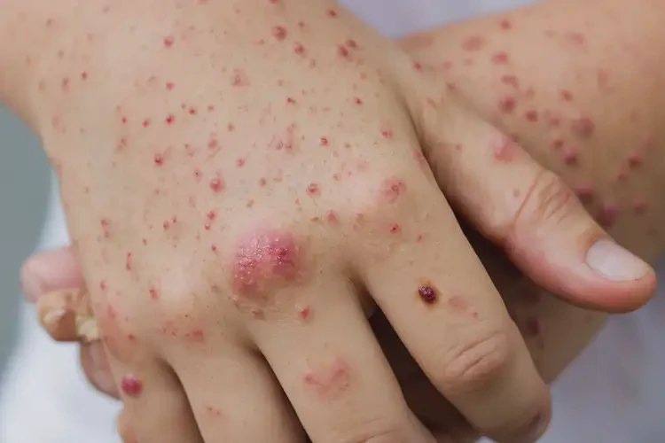 青少年手上出濕疹能不能徹底自愈(圖4)