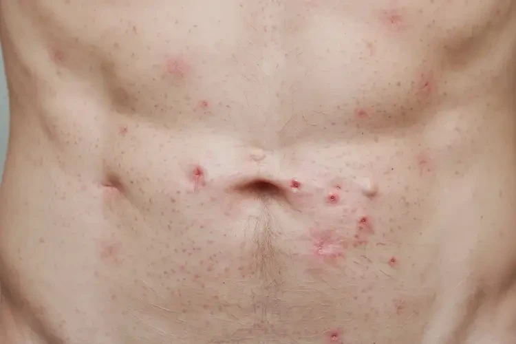 男性肚子出濕疹可不可以根治(圖4)