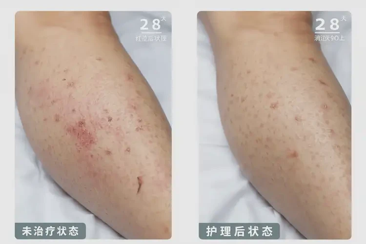 少兒小腿上偶爾長(zhǎng)濕疹能靠自己自愈嗎(圖2)