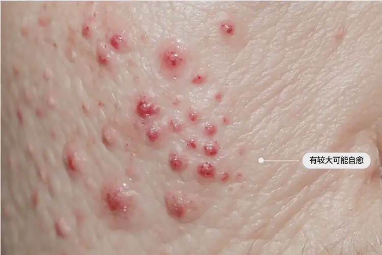 男人大腿上出濕疹可不可以徹底自愈(圖4)