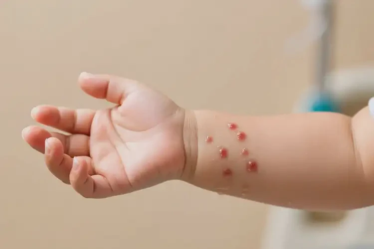 幼兒手臂上有濕疹可不可以根治(圖4)