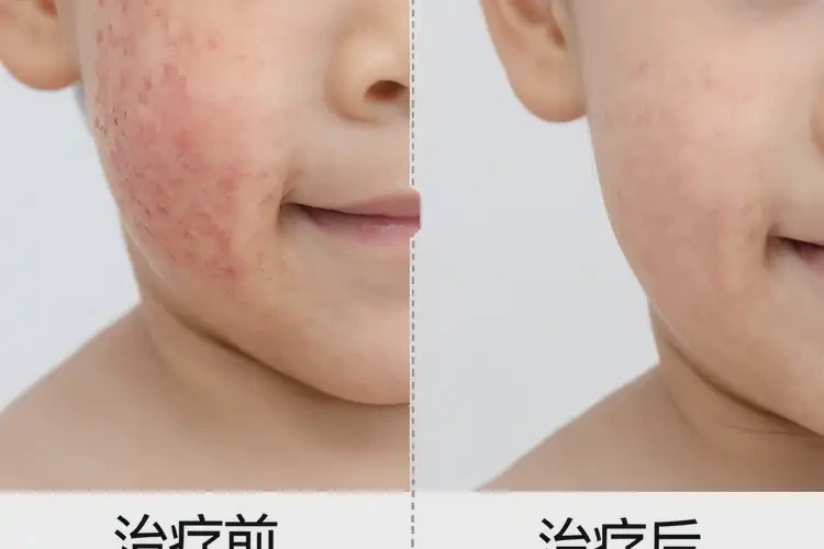 孩子脖子上长湿疹不管它会自己好吗(图1)