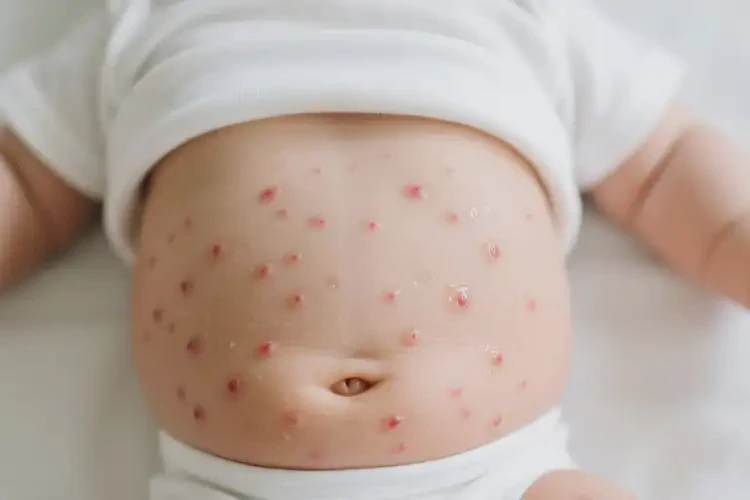 婴儿肚子偶尔长湿疹可不可以根治(图3)